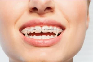 Innowacyjne Rozwiązania w Aparatach Ortodontycznych Doskonały Uśmiech bez Widocznych Śladów